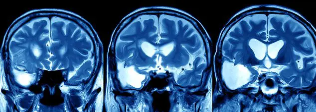 Brain MRI Report